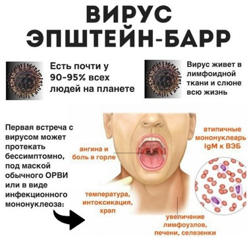 Острая infectious mononucleosis (ВПМ)