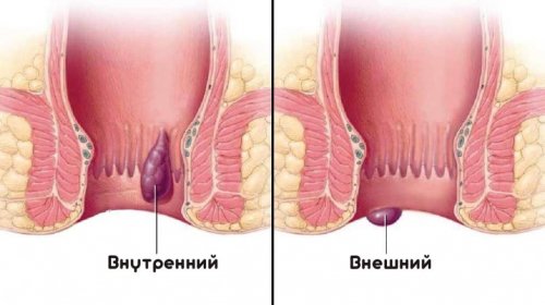 Внутренний и внешний геморрой