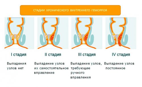 Стадии геморроя