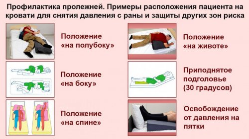 Профилактика пролежней