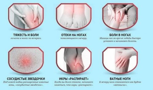 Симптомы варикоза