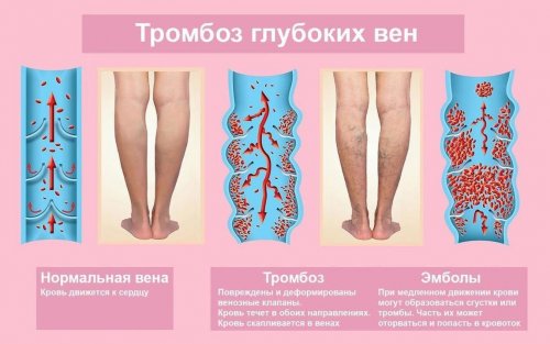 Как развивается тромбоз глубоких вен
