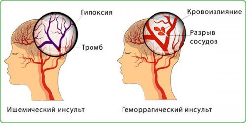 Ишемический и геморрагический инсульты: в чем разница