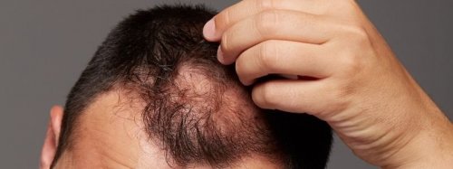 Андрогенетическая алопеция