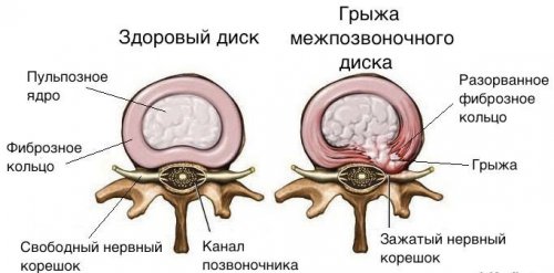 Грыжа межпозвоночного диска