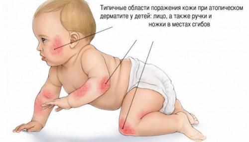 Атопический дерматит у ребенка: локализация