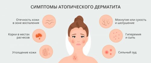 Симптомы атопического дерматита у детей и взрослых