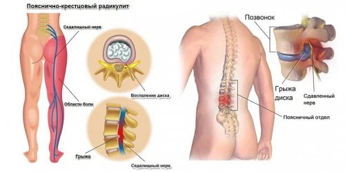Пояснично-крестцовый радикулит