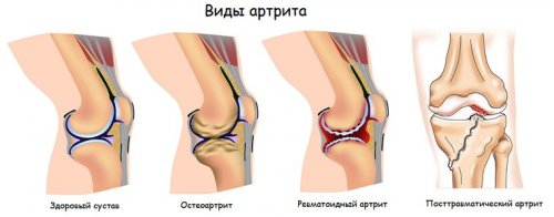 Виды артрита