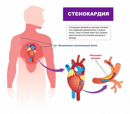 Что такое стенокардия?