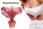 Эндометриоз: причины, симптомы, лечение