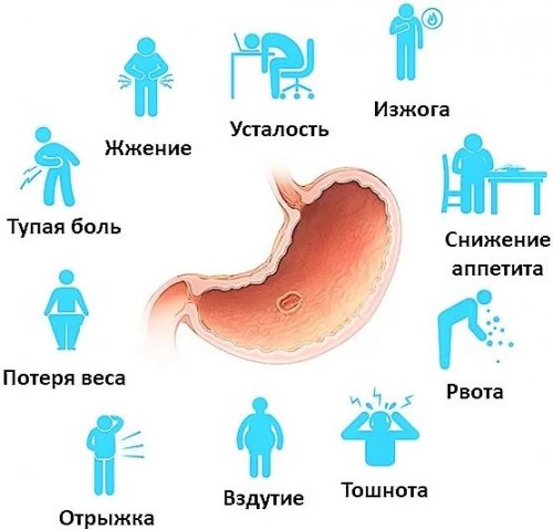 Симптомы язвы желудка