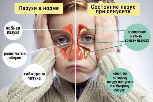 Синусит