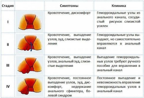 Стадии и симптомы геморроя