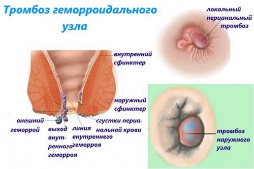 Тромбоз геморроидального узла