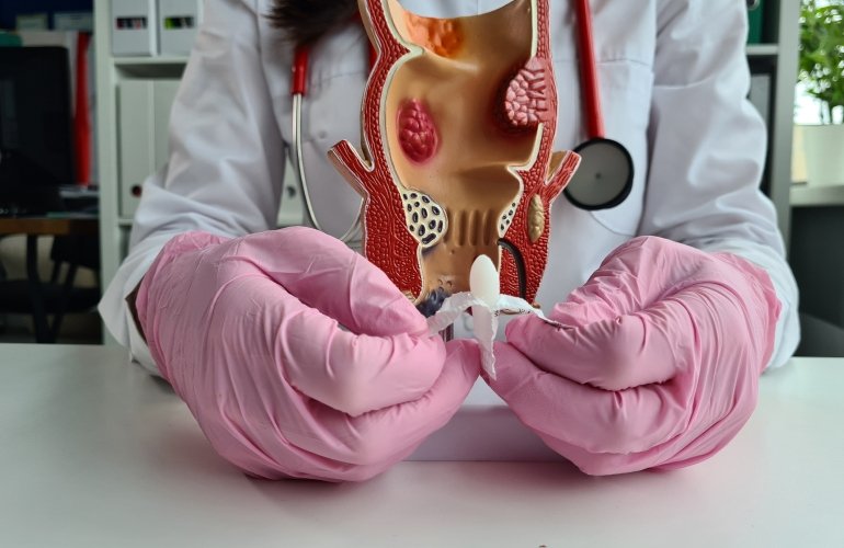 Недорогие свечи от геморроя: топ-7