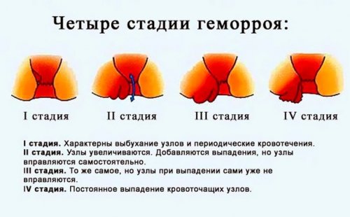 4 стадии геморроя
