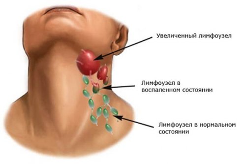 Лимфоузел: в норме, воспаленный и увеличенный