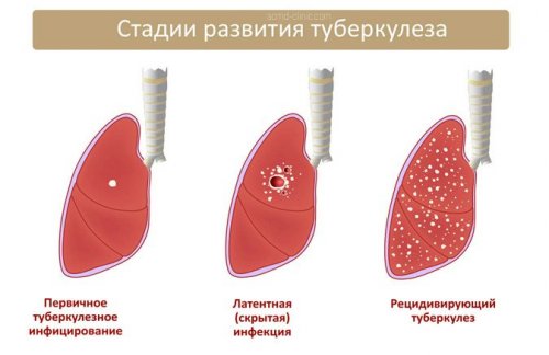 Стадии развития туберкулеза