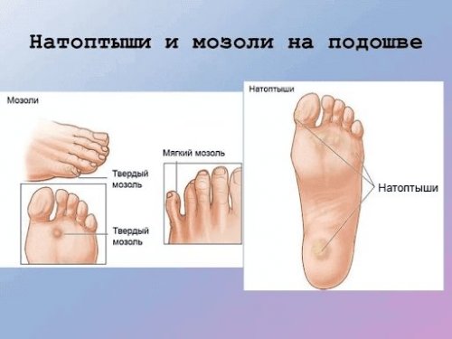 10 лучших кремов, гелей и мазей от мозолей и натоптышей - Здоровье и ...