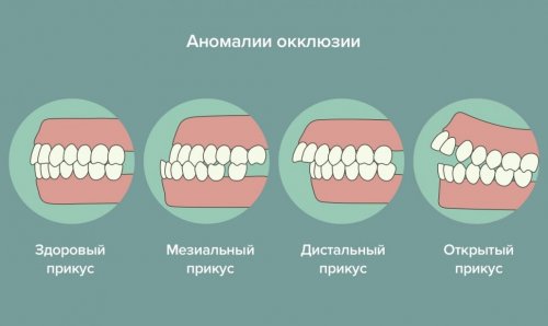 Аномалии прикуса