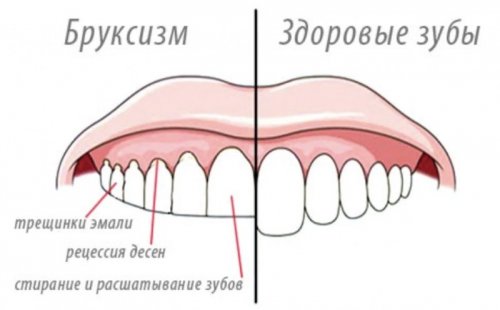 Последствия бруксизма