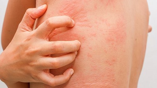 Крапивница