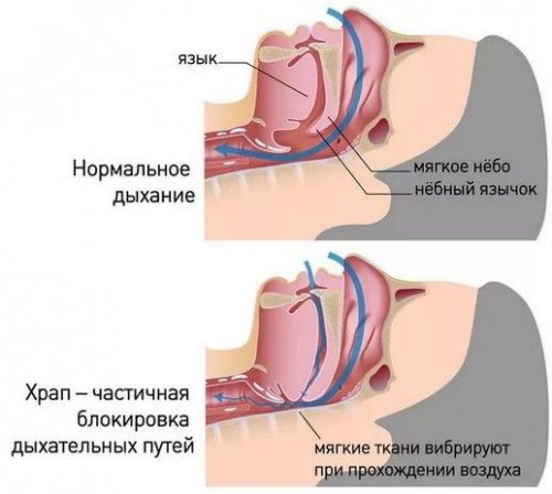 Как возникает храп
