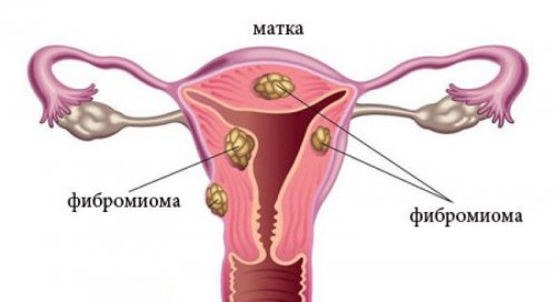 Фибромиома матки