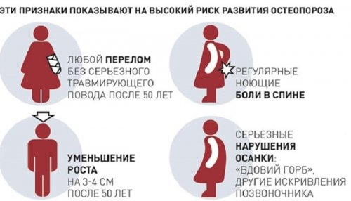Симптомы остеопороза