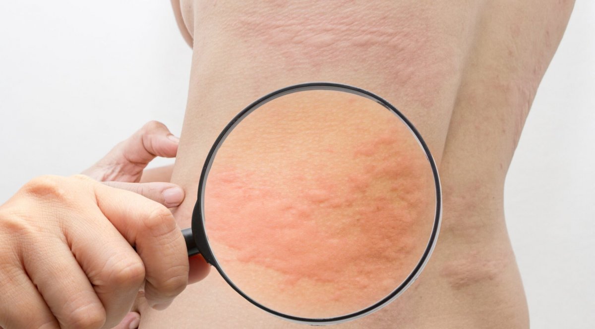 Крапивница: симптомы, причины, лечение