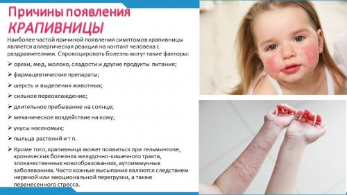 Причины крапивницы