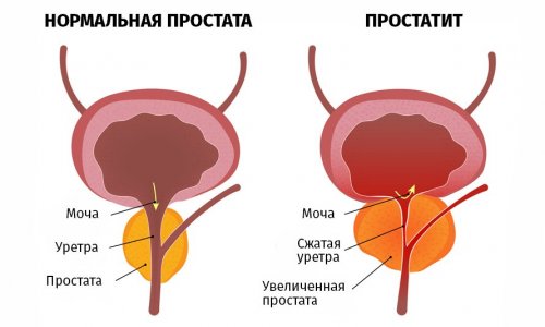 Простатит