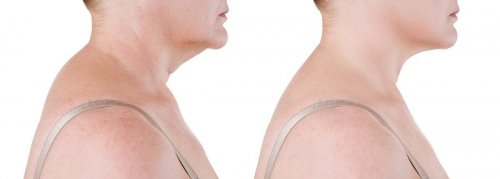 Так выглядит вдовий горб (фото слева)