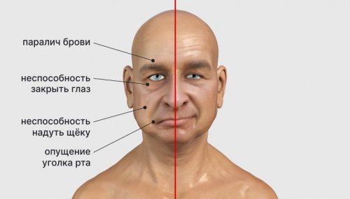 Невралгия тройничного нерва