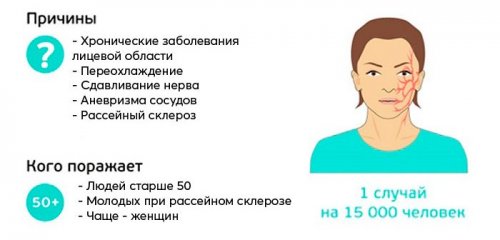 Причины невралгии тройничного нерва