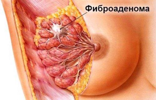 Фиброаденома: причины, симптомы, лечение