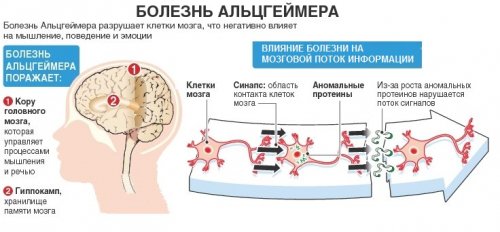 Болезнь Альцгеймера