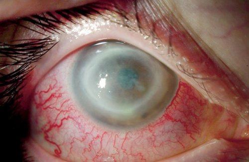 Акантамебный кератит