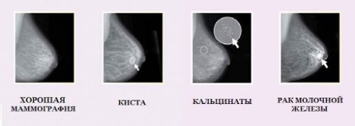 Результаты маммографии