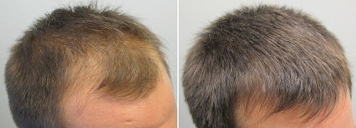 До и после лечения миноксидилом