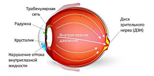 Повышенное внутриглазное давление