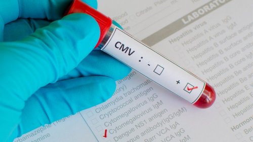 Врачи часто назначают тест на авидность антител к цитомегаловирусу