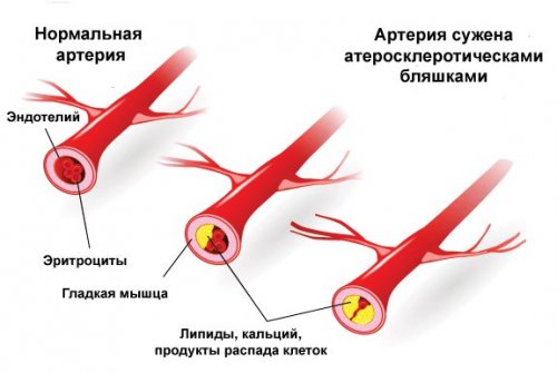 Атеросклероз коронарных артерий