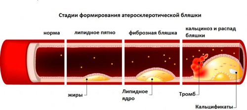 Как формируется атеросклеротическая бляшка