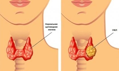 Узел щитовидной железы