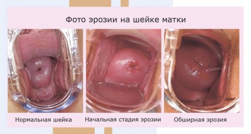 Эрозия шейки матки: норма, начальная стадия и обширная эрозия