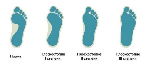 Степени плоскостопия