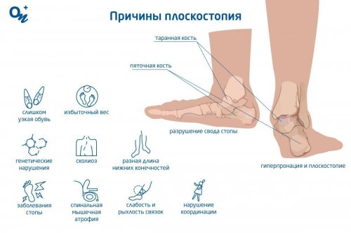 Причины плоскостопия