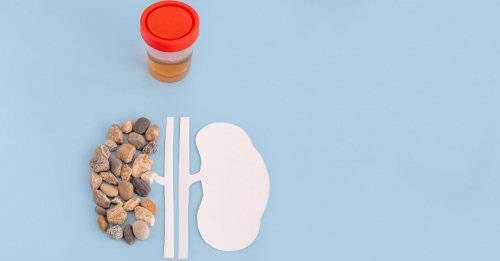 Врачи рассказали, какие продукты вызывают камни в почках